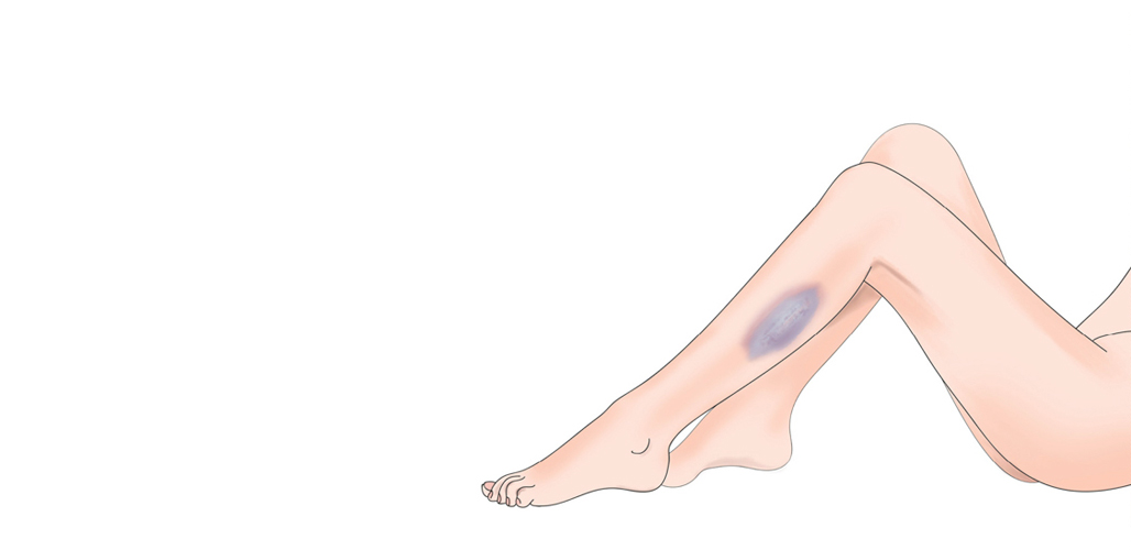 Vedlejší účinky při léčbě warfarinem